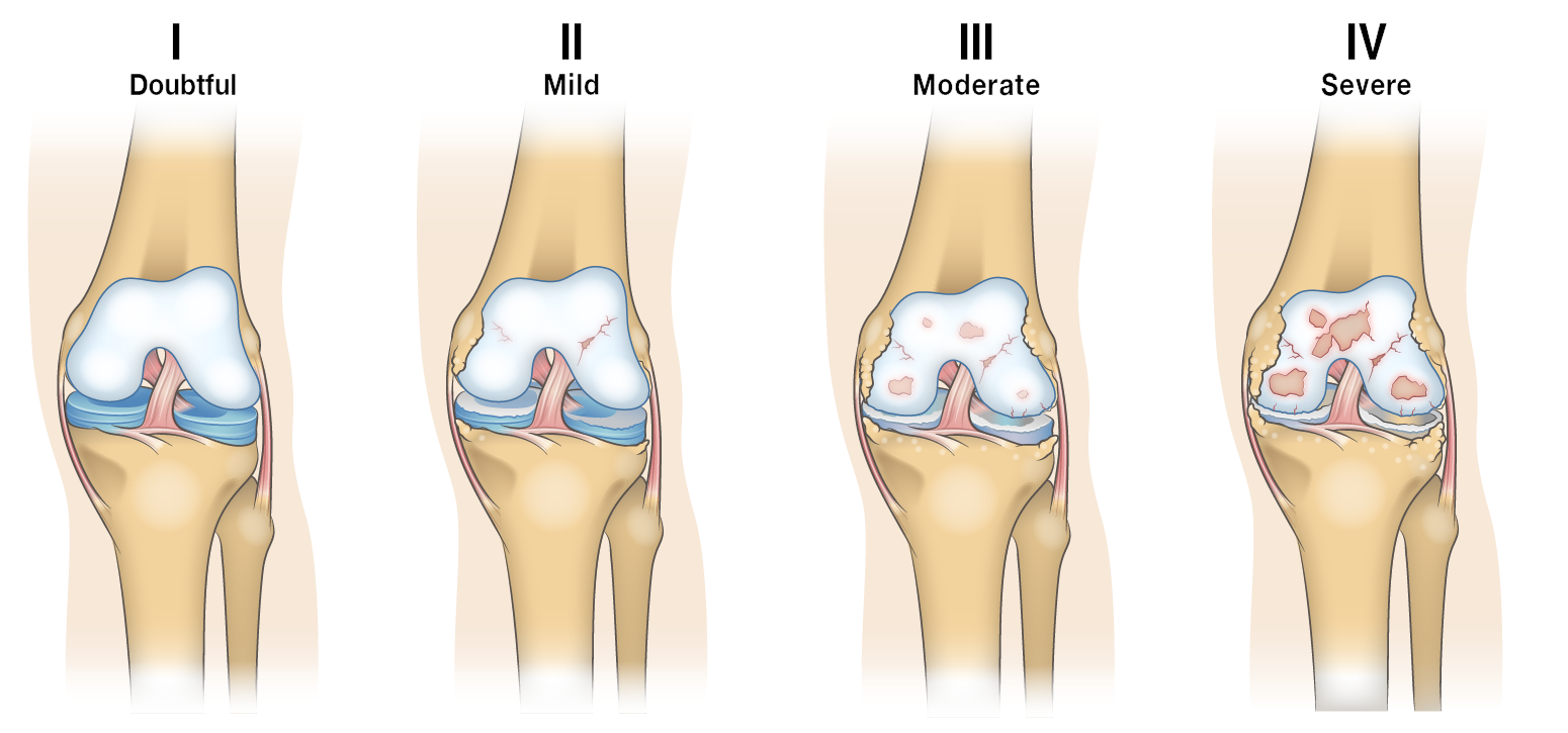 gradi artrosi ginocchio